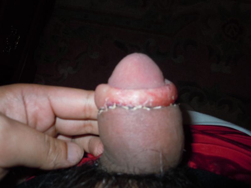 Foreskin taped back fuck like circumcised